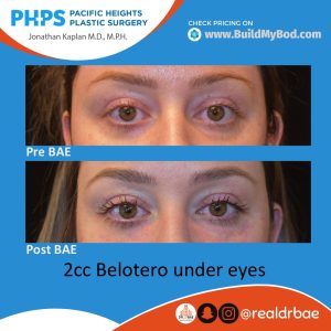 under eye fillers