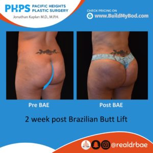 brazilian butt lift