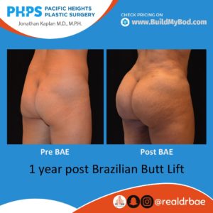 brazilian butt lift