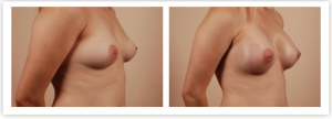 breast augmentation recovery