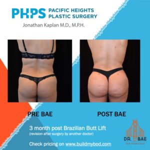 Liposuction of the abdomen and flanks, Plastic Surgeon San Francisco