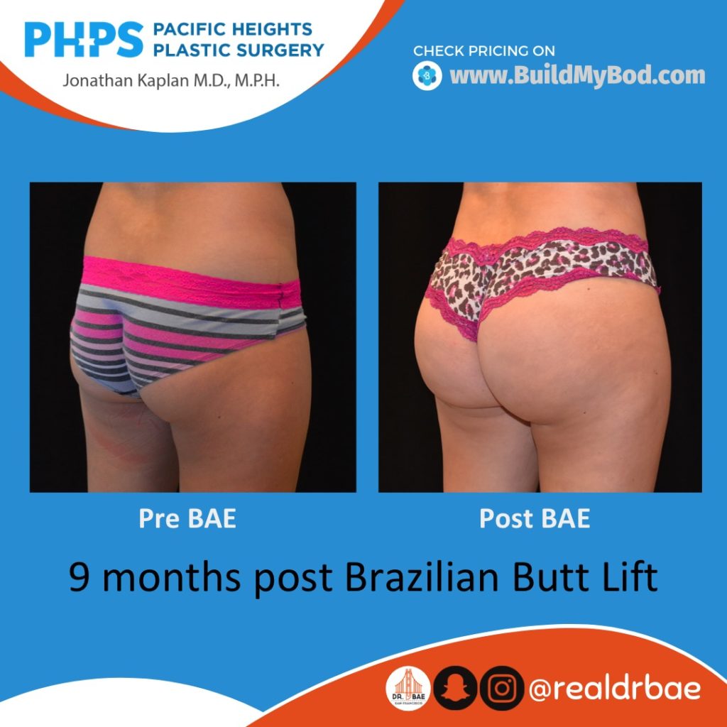 brazilian butt lift