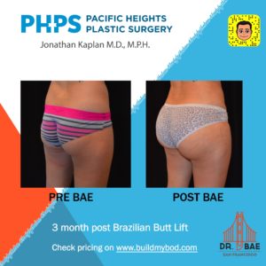 Brazilian Butt Lift with Implants vs Fat, Plastic Surgeon San Francisco