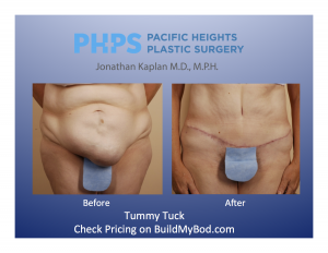 tummy tuck