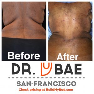 skin removal vs liposuction