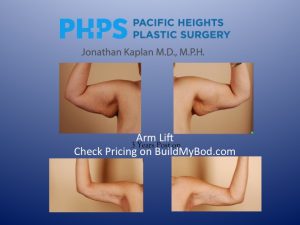 Arm Lift vs Arm Lipo, Plastic Surgeon San Francisco