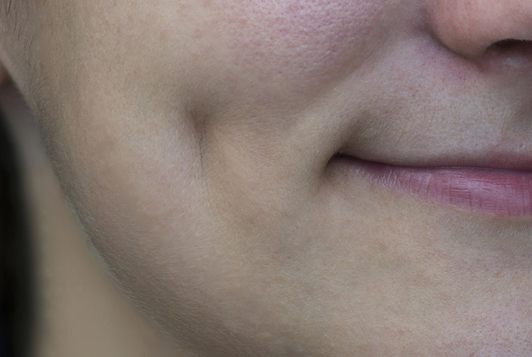 Dimple on a woman's cheek