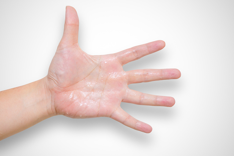 Hyperhidrosis wet hand from sweat syndrome