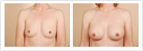 breast augmentation