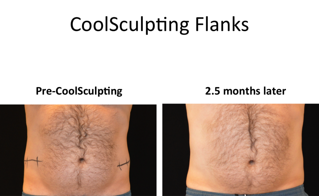 liposuction