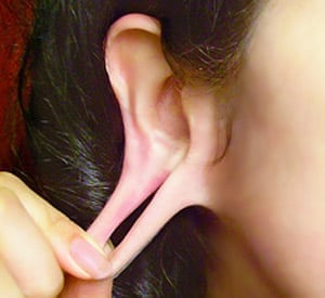 Earlobe after a gauge is removed