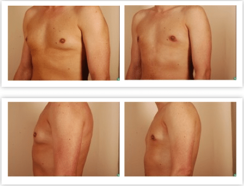 gynecomastia