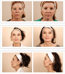 facelift cost