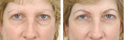 under eye bags