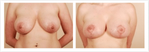 breast symmetry