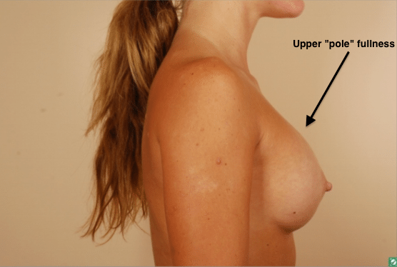 shaped breast implants