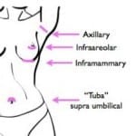 the transaxillary incision