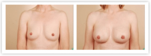 cost of breast augmentation