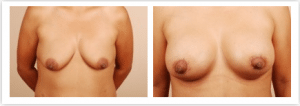 breast symmetry