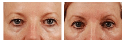 blepharoplasty