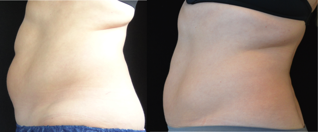 coolsculpting