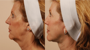 neck lift