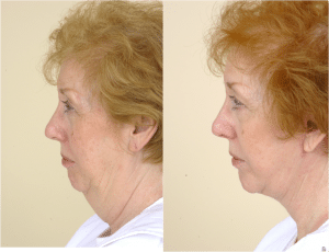 neck lift