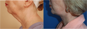 neck lift