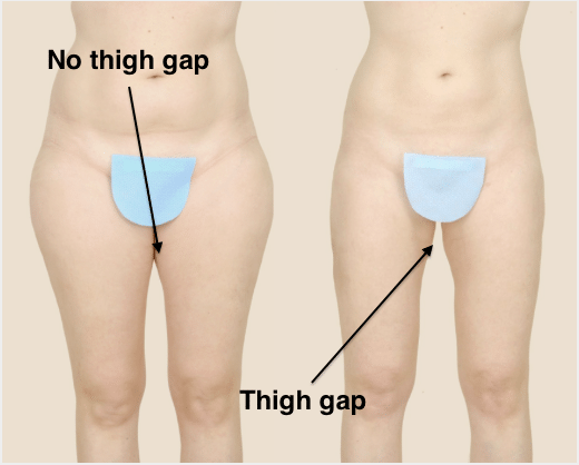 thigh gap