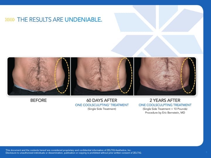 CoolSculpting