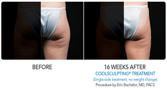 outer thigh fat