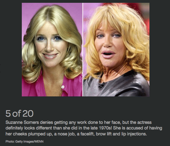 celebrity plastic surgery