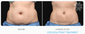 coolsculpting