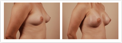 breast augmentation cost