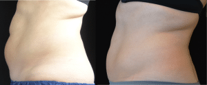 CoolSculpting