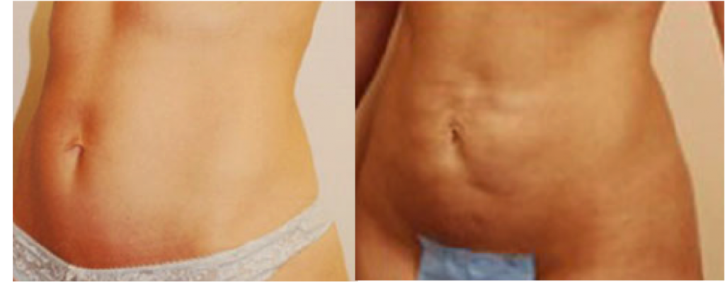 laser lipo