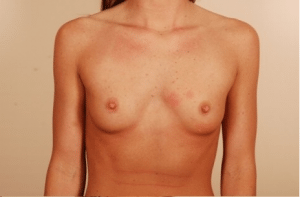 breast augmentation