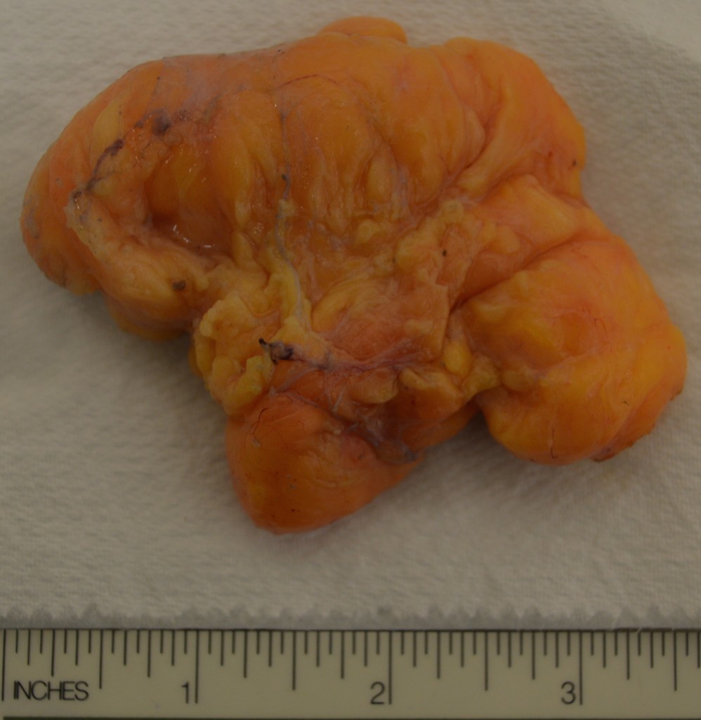 lipoma