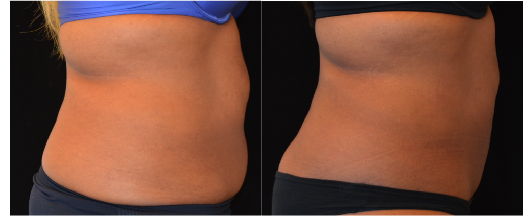 coolsculpting