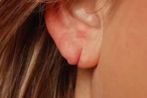 split earlobe repair