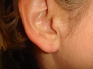 split earlobe repair