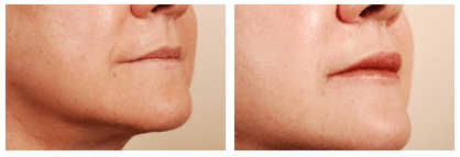 lip augmentation