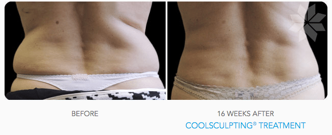 coolsculpting