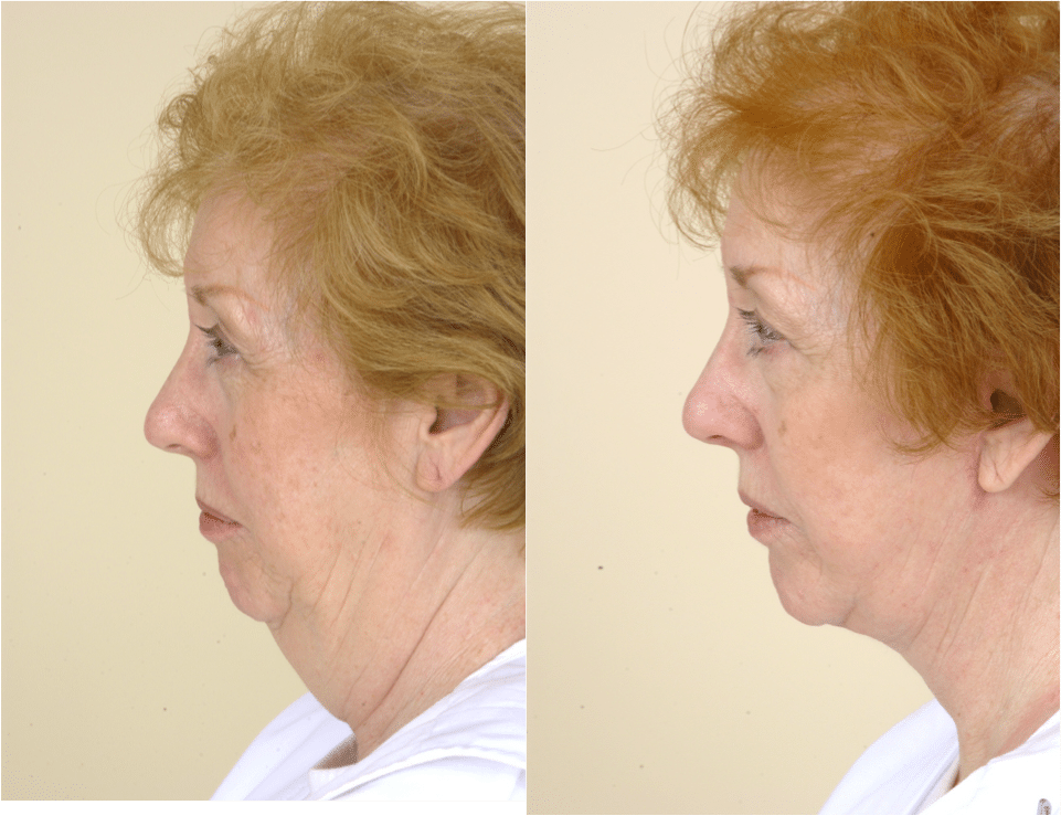 Face lift without surgery