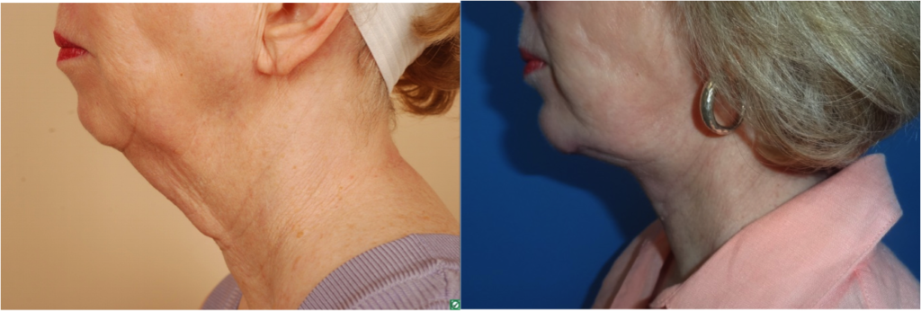 neck lift without the facelift