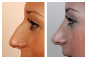 rhinoplasty