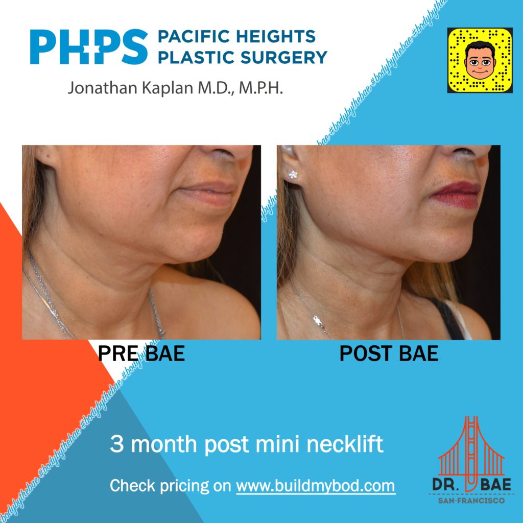 SIMI™ Neck Lift