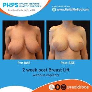 breast lift pricing