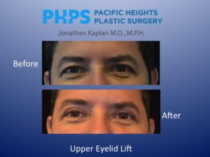 eyelid surgery