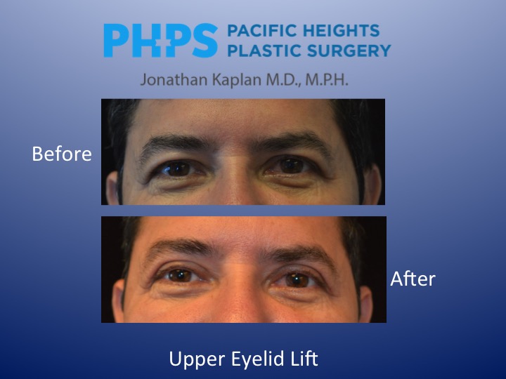 eyelid surgery